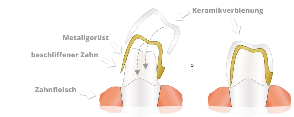 Eine zweiteilige Illustration zeigt das Anbringen einer Keramikverblendkrone. Links ist ein präparierter Zahn mit dem Zahnfleisch dargestellt. Ein goldfarbenes Metallgerüst wird durch gestrichelte Pfeile über den Zahn bewegt. Darüber ist eine weiße Keramikverblendung angedeutet. Der Zahn, das Zahnfleisch und das Metallgerüst sind beschriftet. Rechts ist derselbe Zahn mit dem vollständig aufgesetzten Metallgerüst und der darüber liegenden weißen Keramikverblendung zu sehen. Ein Pfeil weist auf die fertige Keramikverblendung.