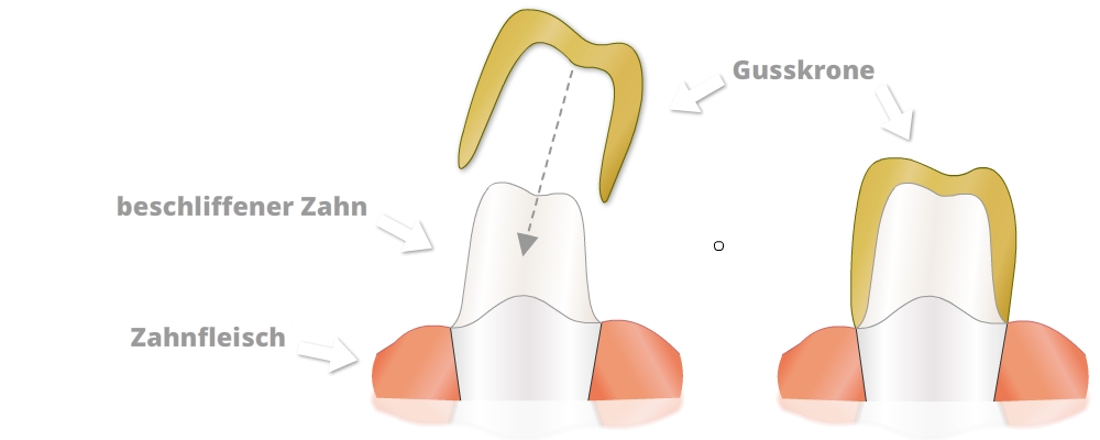 Eine zweiteilige Illustration zeigt das Anbringen einer Gusskrone. Links ist ein präparierter Zahn mit dem Zahnfleisch dargestellt. Eine goldfarbene Gusskrone schwebt darüber und wird durch einen gestrichelten Pfeil nach unten in Richtung des Zahns bewegt. Der Zahn und das Zahnfleisch sind beschriftet. Rechts ist derselbe Zahn mit der vollständig aufgesetzten, goldfarbenen Gusskrone zu sehen. Ein Pfeil weist auf die fertige Gusskrone.